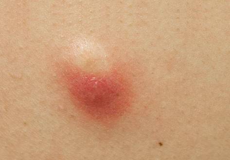 Typische Symptome einer Atherom