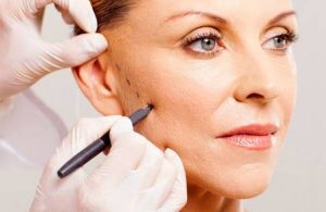 Gesichtsfett weg machen lassen bei Dr- Knapp