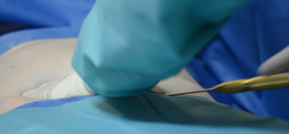  Liposuktion bei Männer Dr. Knapp