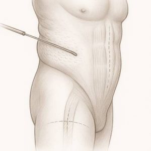 Liposkulptur KFA optimieren Bauchdecke Dr.Knapp