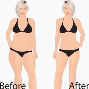 Techniken & Schnittführungen vorher nachherMommy Makeover